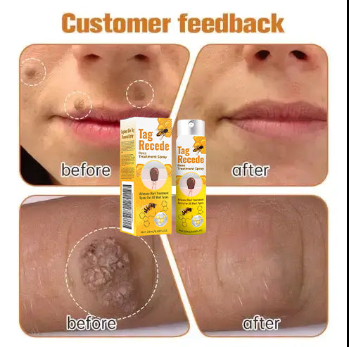 LOVILDS™ TagRecede Bee Venom Wart Treatment Spray -⚠️ Last 4 Days: 40% Off!⏰