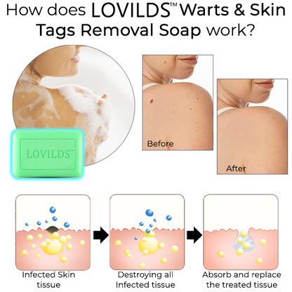 LOVILDS™ Warts & Skin Tags Removal Soap✨(⏳ FINAL DAY! Buy 1 Get 1 FREE! ⏳)