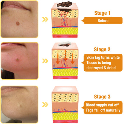 LOVILDS™ TagRecede Bee Venom Wart Treatment Spray -⚠️ Last 4 Days: 40% Off!⏰