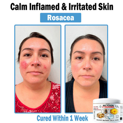 LOVILDS™✨ Bee Poison 𝑴𝒖𝒍𝒕𝒊-𝑺𝒚𝒎𝒑𝒕𝒐𝒎 𝑺𝒌𝒊𝒏 𝑻𝒓𝒆𝒂𝒕𝒎𝒆𝒏𝒕 𝑪𝒓𝒆𝒂𝒎 (👨‍⚕𝑵𝑷𝑭 𝑹𝑬𝑪𝑶𝑴𝑴𝑬𝑵𝑫𝑺)
