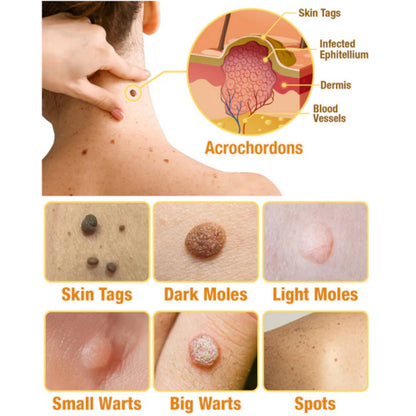 LOVILDS™ TagRecede Bee Venom Wart Treatment Spray -⚠️ Last 4 Days: 40% Off!⏰