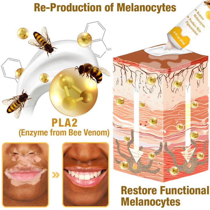 LOVILDS™ Bee Vitiligo Treatment Cream