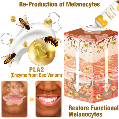 LOVILDS™ Bee Vitiligo Treatment Cream