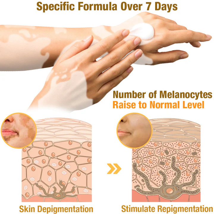 LOVILDS™ Bee Vitiligo Treatment Cream