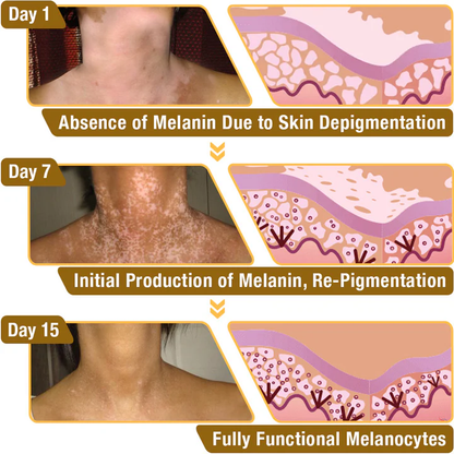 LOVILDS™ Bee Vitiligo Treatment Cream