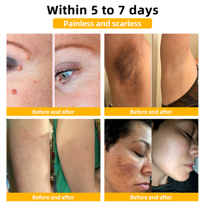 LOVILDS™ TagRecede Bee Venom Wart Treatment Spray -⚠️ Last 4 Days: 40% Off!⏰