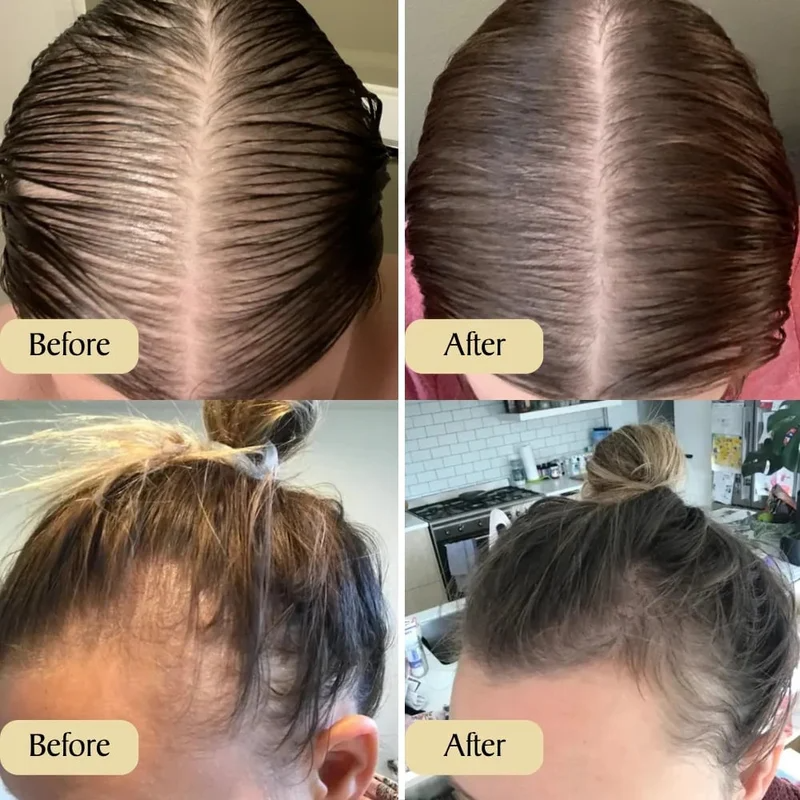 Last day to get over 49% off-BBOJI™✨Natural Hair Growth Oil