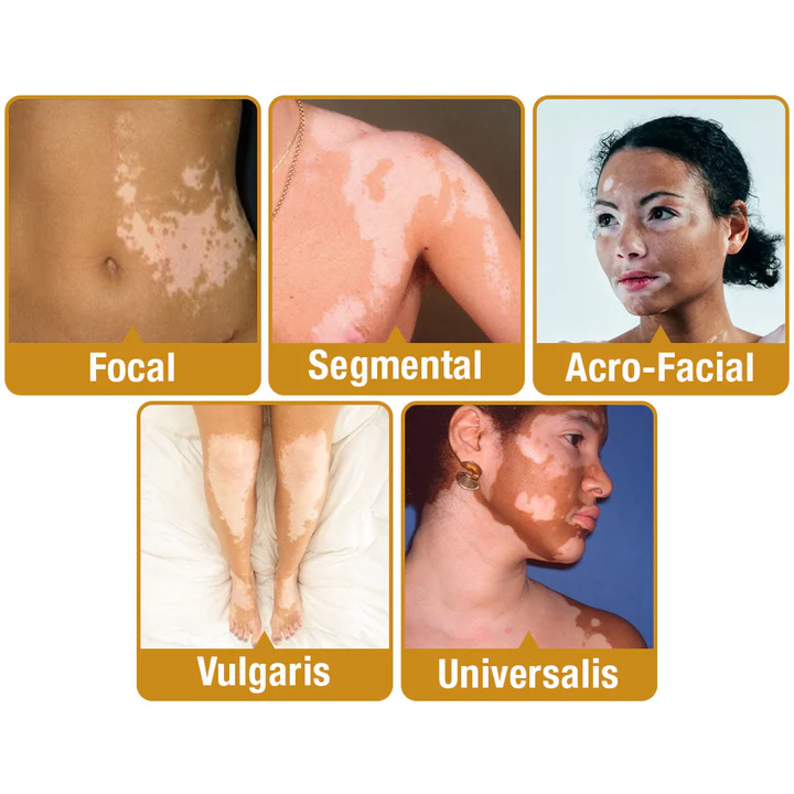 LOVILDS™ Bee Vitiligo Treatment Cream
