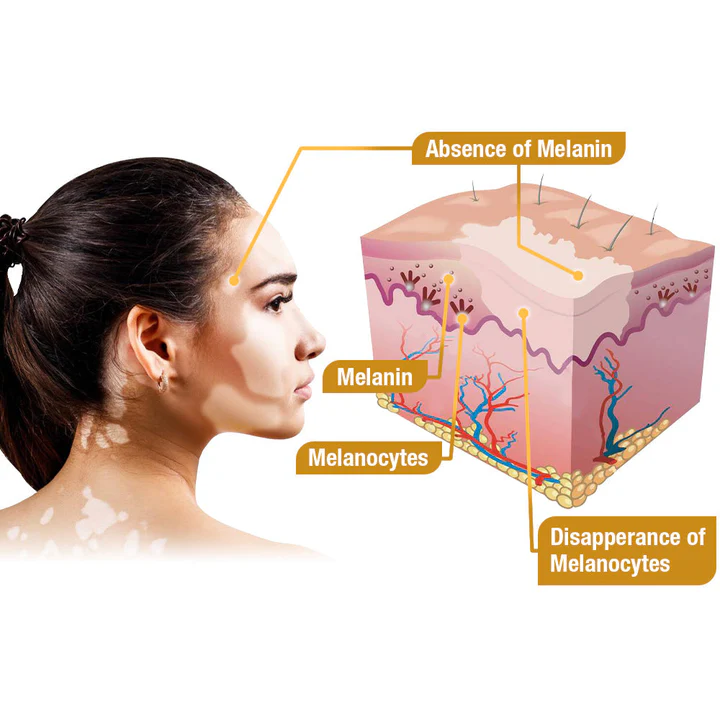 LOVILDS™ Bee Vitiligo Treatment Cream
