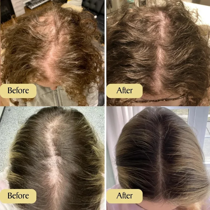Last day to get over 49% off-BBOJI™✨Natural Hair Growth Oil